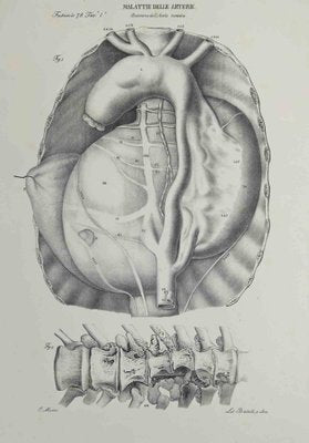 Ottavio Muzzi, Artery Disease, Lithograph, 1843-ZCI-2029979