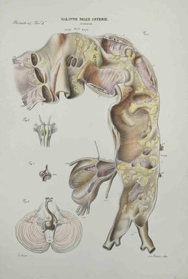 Ottavio Muzzi, Artery Disease, Lithograph, 1843-ZCI-2029996