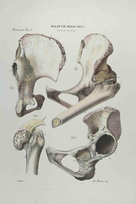 Ottavio Muzzi, Bone Disease, Lithograph, 1843-ZCI-2029978