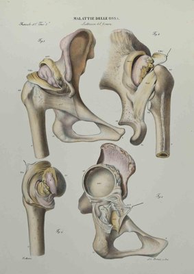 Ottavio Muzzi, Bone Disease, Lithograph, 1843-ZCI-2029984