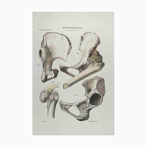 Ottavio Muzzi, Bone Disease, Lithograph, 1843-ZCI-2029978