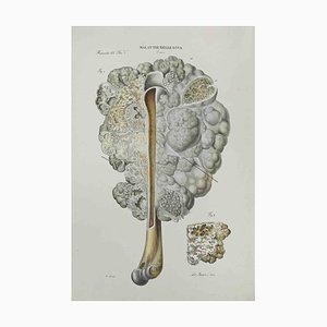 Ottavio Muzzi, Bone Disease, Lithograph, 1843-ZCI-2029994