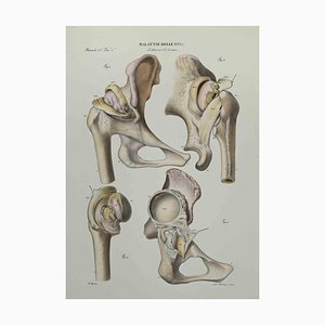 Ottavio Muzzi, Bone Disease, Lithograph, 1843-ZCI-2029984