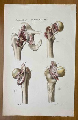 Ottavio Muzzi, Bone Diseases, Lithograph, 1843-ZCI-2030163