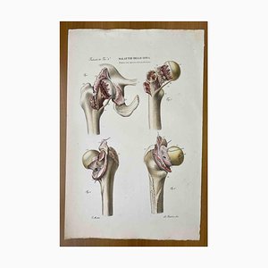 Ottavio Muzzi, Bone Diseases, Lithograph, 1843-ZCI-2030163