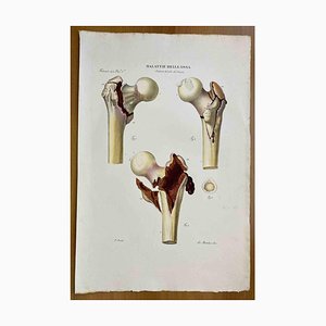 Ottavio Muzzi, Bone Diseases, Lithograph, 1843-ZCI-2030148