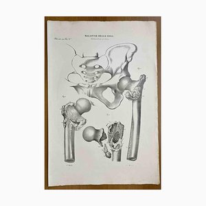 Ottavio Muzzi, Bone Diseases, Lithograph, 1843-ZCI-2030149