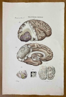 Ottavio Muzzi, Brain Disease, Lithograph, 1843-ZCI-2030156