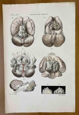 Ottavio Muzzi, Brain Diseases, Lithograph, 1843-ZCI-2030171