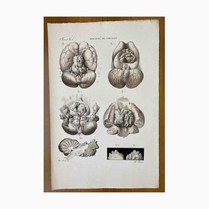 Ottavio Muzzi, Brain Diseases, Lithograph, 1843-ZCI-2030171