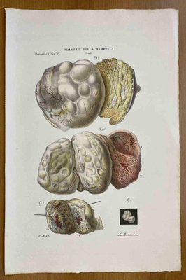 Ottavio Muzzi, Breast Diseases, Lithograph, 1843-ZCI-2030161