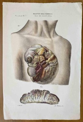 Ottavio Muzzi, Breast Diseases, Lithograph, 1843-ZCI-2030129