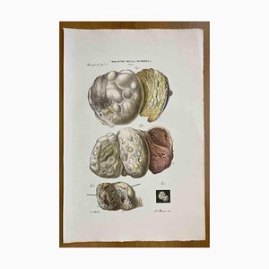 Ottavio Muzzi, Breast Diseases, Lithograph, 1843-ZCI-2030161