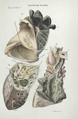 Ottavio Muzzi, Diseases of the Brain, Lithograph, 1843-ZCI-2029989