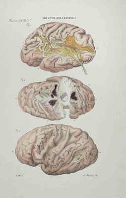 Ottavio Muzzi, Diseases of the Brain, Lithograph, 1843-ZCI-2029988