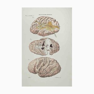 Ottavio Muzzi, Diseases of the Brain, Lithograph, 1843-ZCI-2029988