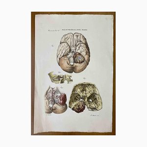 Ottavio Muzzi, Diseases of the Dura Mater, Lithograph, 1843-ZCI-2030162