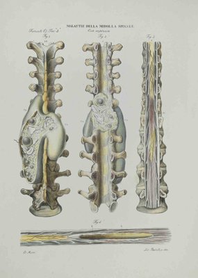 Ottavio Muzzi, Diseases of the Spinal Cord, Lithograph, 1843-ZCI-2029975