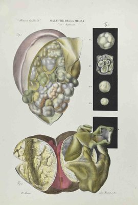 Ottavio Muzzi, Diseases of the Spleen, Lithograph, 1843-ZCI-2029992