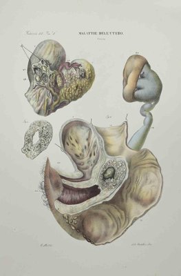 Ottavio Muzzi, Diseases of the Uterus, Lithograph, 1843-ZCI-2029995