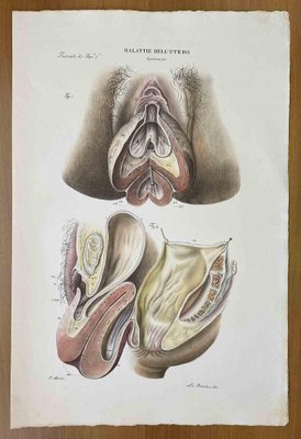 Ottavio Muzzi, Diseases of the Uterus, Lithograph, 1843-ZCI-2030164