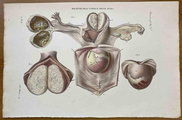 Ottavio Muzzi, Diseases of Uterus, Lithograph, 1843-ZCI-2030140