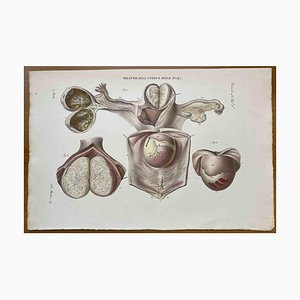 Ottavio Muzzi, Diseases of Uterus, Lithograph, 1843-ZCI-2030140