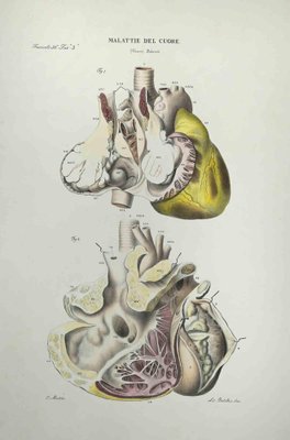 Ottavio Muzzi, Heart Disease, Lithograph, 1843-ZCI-2029982