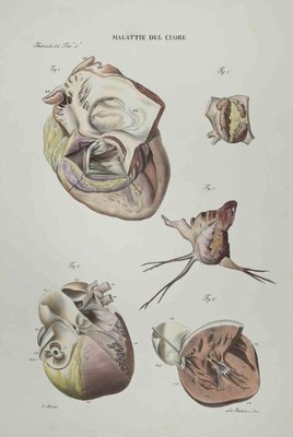 Ottavio Muzzi, Heart Disease, Lithograph, 1843-ZCI-2029997