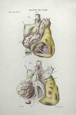 Ottavio Muzzi, Heart Disease, Lithograph, 1843-ZCI-2029977