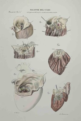 Ottavio Muzzi, Heart Disease, Lithograph, 1843-ZCI-2029998