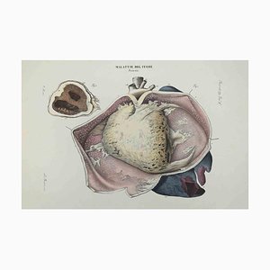 Ottavio Muzzi, Heart Disease, Lithograph, 1843-ZCI-2029966