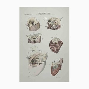 Ottavio Muzzi, Heart Disease, Lithograph, 1843-ZCI-2029998