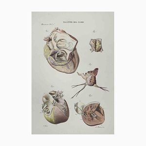 Ottavio Muzzi, Heart Disease, Lithograph, 1843-ZCI-2029997