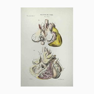 Ottavio Muzzi, Heart Disease, Lithograph, 1843-ZCI-2029982