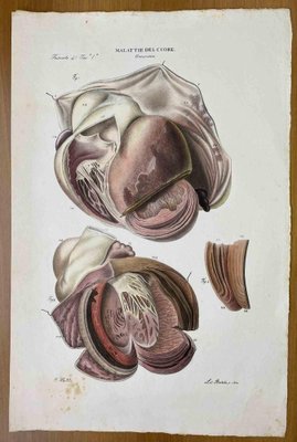 Ottavio Muzzi, Heart Diseases, Lithograph, 1843-ZCI-2030168