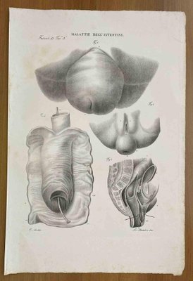 Ottavio Muzzi, Intestinal Diseases, Lithograph, 1843-ZCI-2030143