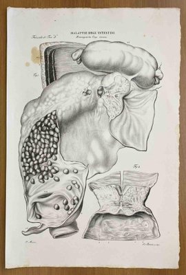 Ottavio Muzzi, Intestinal Diseases, Lithograph, 1843-ZCI-2030166