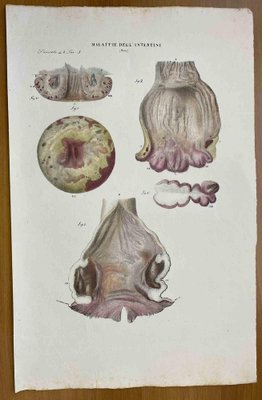 Ottavio Muzzi, Intestine Diseases, Lithograph, 1843-ZCI-2030157