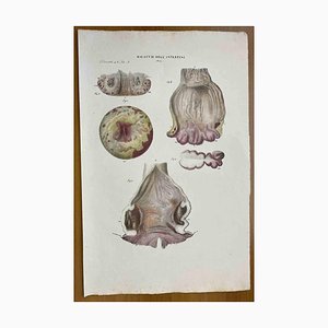 Ottavio Muzzi, Intestine Diseases, Lithograph, 1843-ZCI-2030157