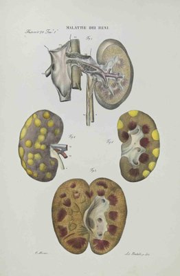 Ottavio Muzzi, Kidney Disease, Lithograph, 1843-ZCI-2030000