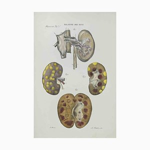 Ottavio Muzzi, Kidney Disease, Lithograph, 1843-ZCI-2030000