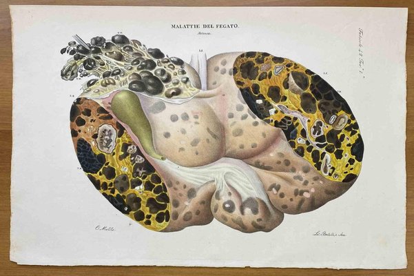 Ottavio Muzzi, Liver Disease, Lithograph, 1843-ZCI-2030144