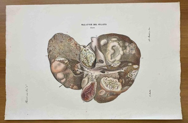 Ottavio Muzzi, Liver Disease, Lithograph, 1843-ZCI-2030150