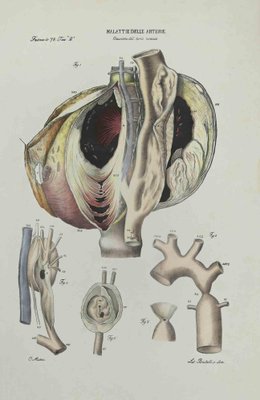 Ottavio Muzzi, Liver Disease, Lithograph, 1843-ZCI-2029969