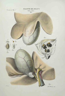 Ottavio Muzzi, Liver Disease, Lithograph, 1843-ZCI-2029983