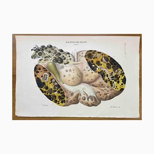 Ottavio Muzzi, Liver Disease, Lithograph, 1843-ZCI-2030144