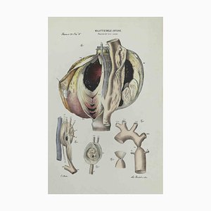 Ottavio Muzzi, Liver Disease, Lithograph, 1843-ZCI-2029969