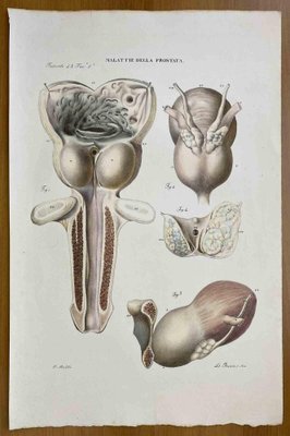 Ottavio Muzzi, Prostate Diseases, Lithograph, 1843-ZCI-2030152