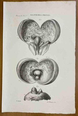 Ottavio Muzzi, Prostate Diseases, Lithograph, 1843-ZCI-2030167